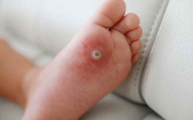 The simplest treatment method for warts on the soles of