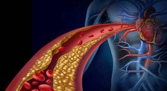 Think again before you eat It clogs the arteries increases