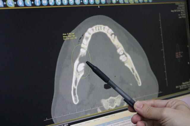 the-tumor-in-jaw-removed-missing-remaining-ground-bone-from-leg-placed_2101_dhaphoto2 (1)