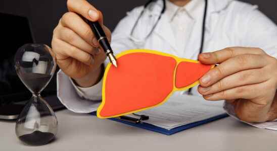 Cirrhosis of the liver symptoms what life expectancy