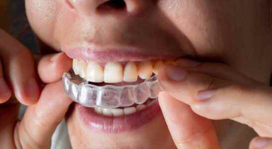 Dental aligners beware of the solutions offered remotely and online