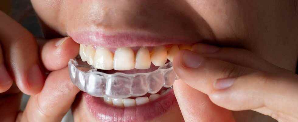 Dental aligners beware of the solutions offered remotely and online