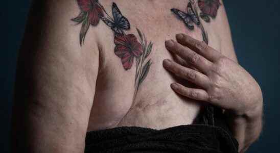 In the Netherlands a free tattoo for survivors of breast
