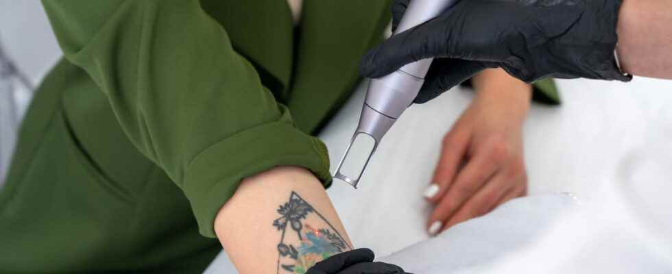Removing a tattoo how pain risk
