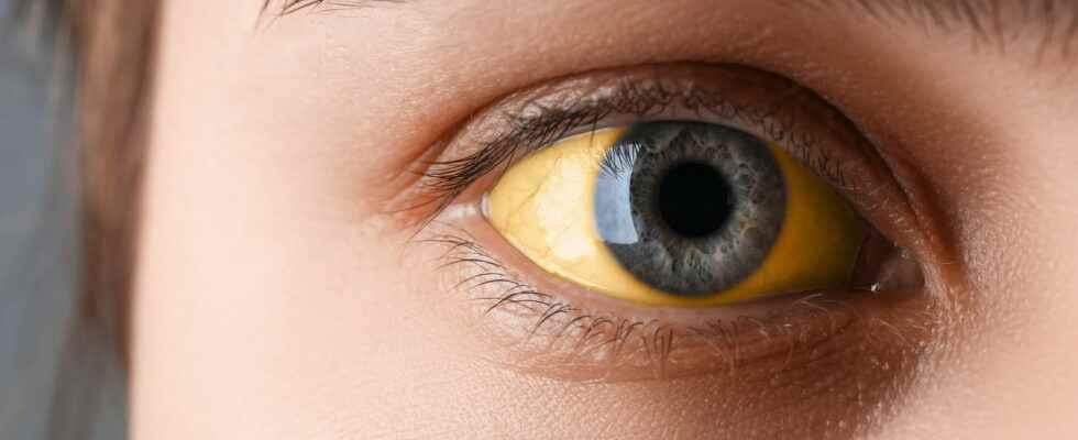 What causes jaundice jaundice