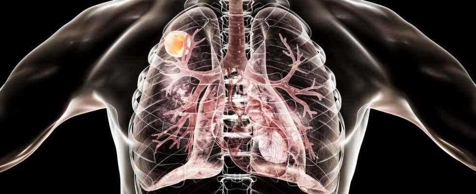 Aspergillosis transmission symptoms cure