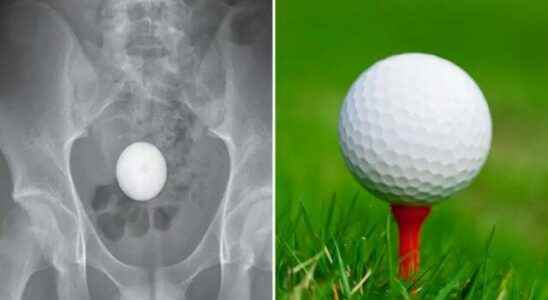 Doctors were stunned When he couldnt get the golf ball