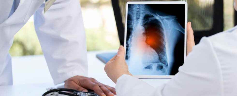Lung cancer artificial intelligence capable of predicting cancer 6 years