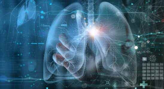 Lung cancer artificial intelligence twice as effective as humans in
