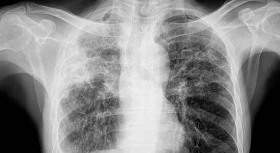 Pulmonary opacity definition causes X ray treatment
