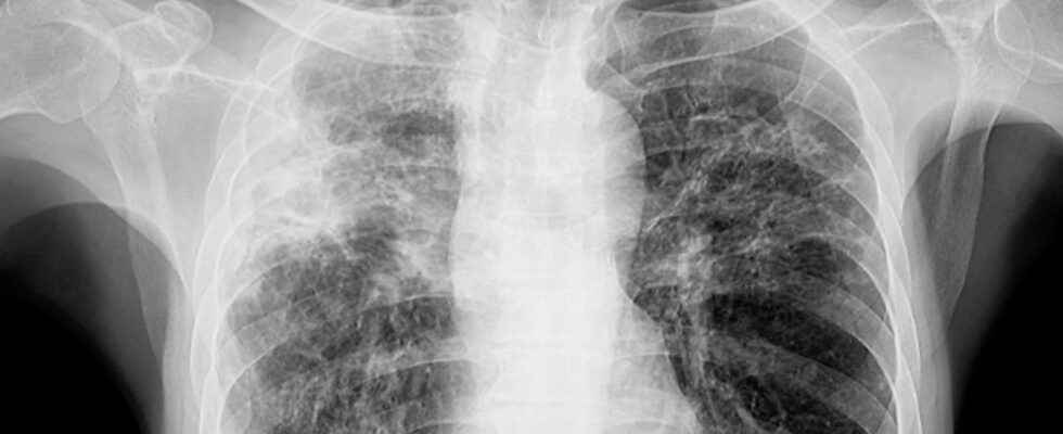 Pulmonary opacity definition causes X ray treatment
