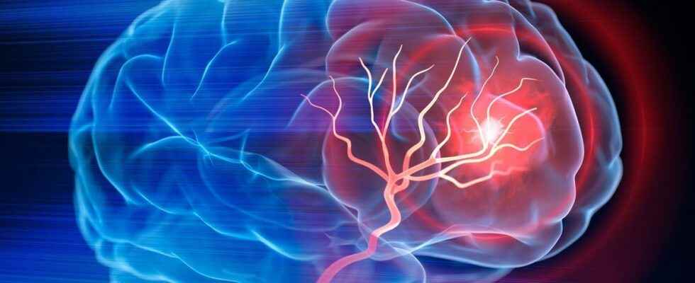 Stroke thrombectomy also improves the most serious cases